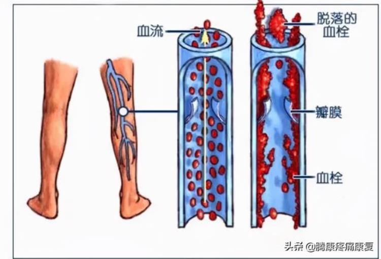 小腿疼痛的原因和治疗原则「小腿疼痛的原因和治疗原则」