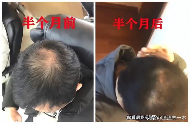 头发掉了洗什么洗发水能长起来「秃掉的头发为什么突然长出来如何选择洗发水」