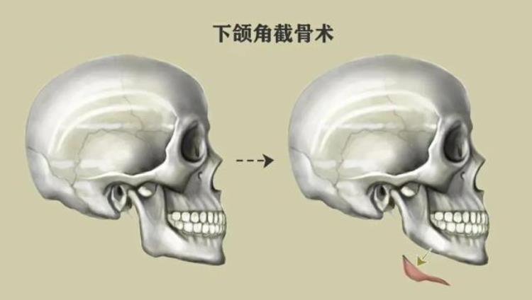 上海九院韦敏做下颌角价格「九院韦敏|如何安全告别国字脸下颌角宽大如何改善」