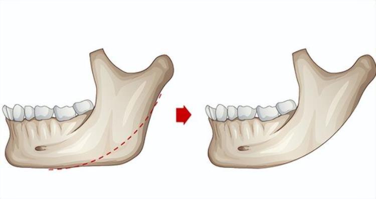 上海九院韦敏做下颌角价格「九院韦敏|如何安全告别国字脸下颌角宽大如何改善」