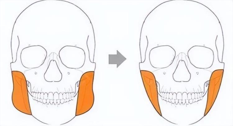 上海九院韦敏做下颌角价格「九院韦敏|如何安全告别国字脸下颌角宽大如何改善」