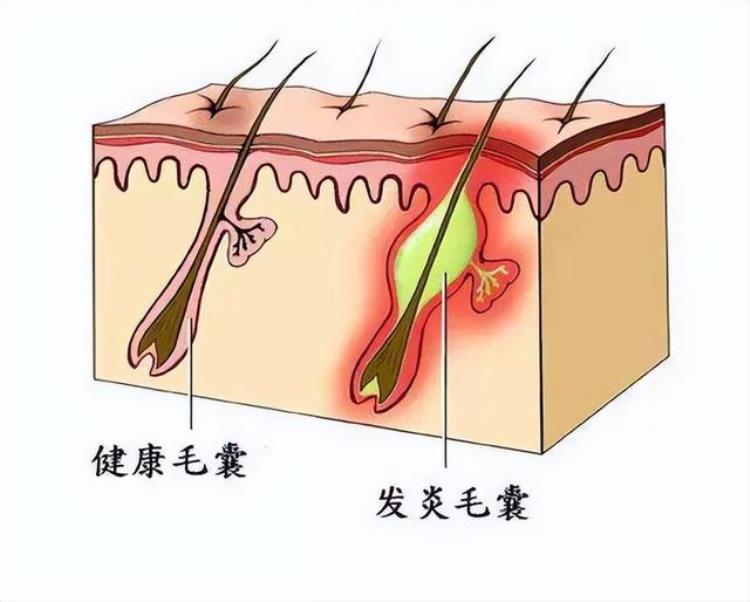 头皮上一直长脓包「为什么头皮上总长脓包和疙瘩提醒或许是这5种原因」