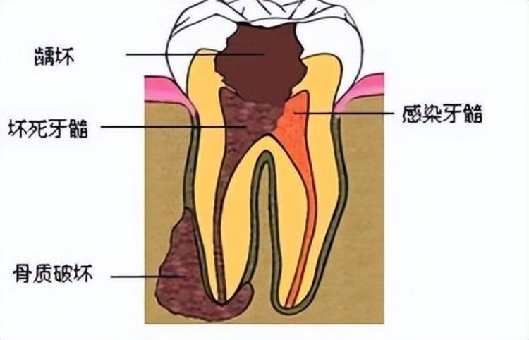 牙痛不一定是蛀牙经常牙痛要警惕这5种口腔疾病