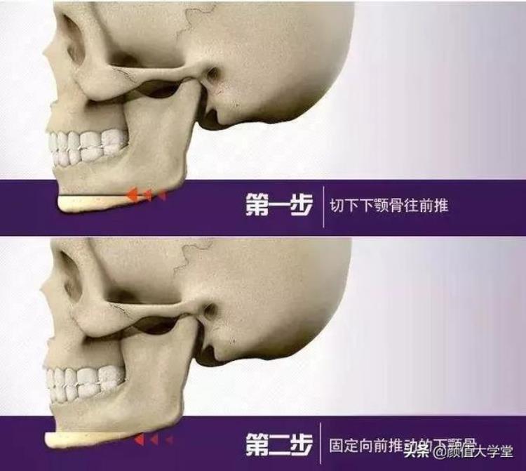 下巴后缩 原因,下巴后缩的侧颜