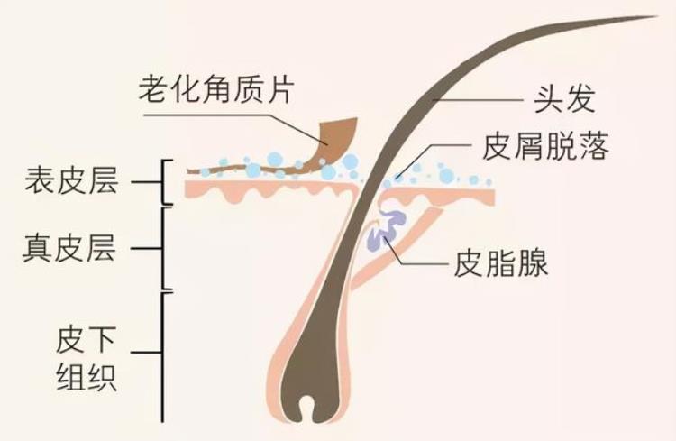 头皮屑多导致脱发「来自皮肤科医生的警告头屑多可能是脱发前兆」