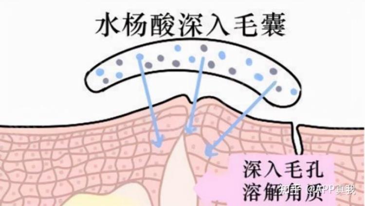 原来刷酸后爆痘不需要停用产品吧「原来刷酸后爆痘不需要停用产品」