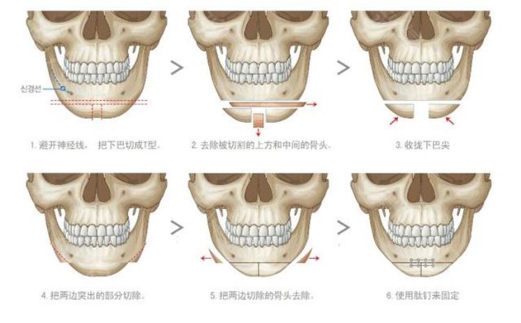 下巴对颜值的改变「这三种形态下巴严重影响颜值进行改善后颜值飞升」