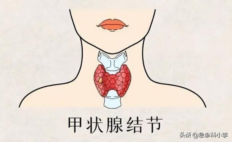 结节不能吃牛肉「牛肉是结节催化剂再次提醒不想结节恶化3种食物要少吃」