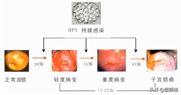 为何总让女性接种hpv疫苗男性就可以置身事外呢「为何总让女性接种HPV疫苗男性就可以置身事外」