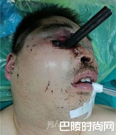 男子命悬一线！ 金属管插入男子眼部深入颅内10多厘米