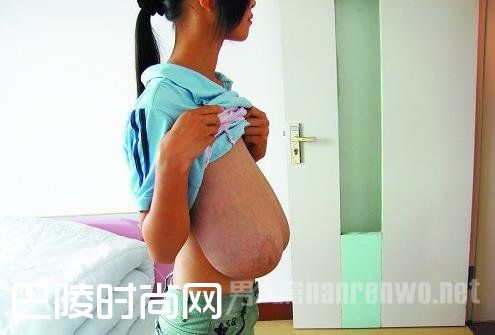 女童患上巨乳症 胸部疯狂增长极度下垂