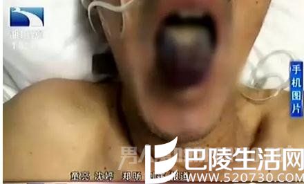 奇！老汉血液变蓝紫色 舌苔恐怖究竟咋回事