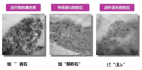 优化皮肤的“八个度”！你不了解的Picoway超皮秒