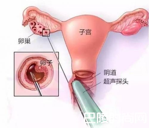 女大学生卖卵20颗秒换苹果7？卖卵子黑中介内幕大揭秘