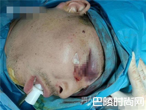 男子命悬一线！ 金属管插入男子眼部深入颅内10多厘米