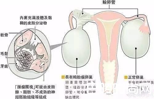 女子怀孕17年怎么回事？腹中竟然取出一团头发和牙齿