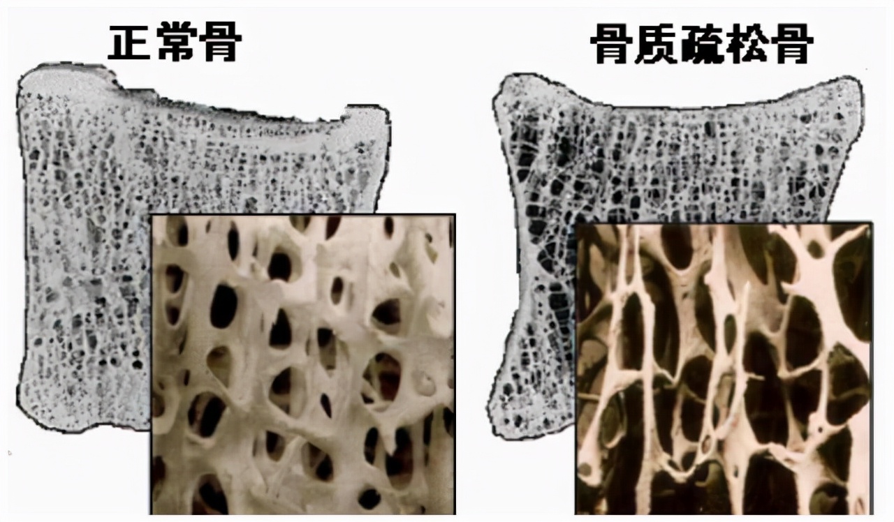 缺钙的十大症状是什么（缺钙会出现什么症状怎么治疗）