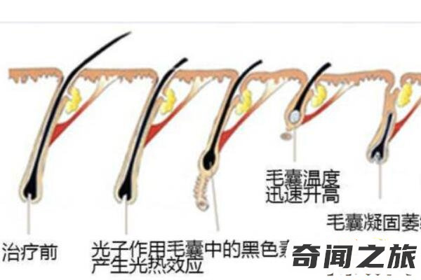 激光脱毛6年后后悔没有早点做（激光脱毛留下黑斑）