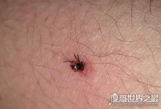 蜱虫咬人后有什么症状，轻者会大面积红肿(严重会持续高烧致死)