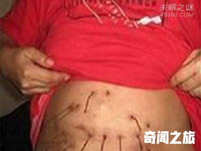 幼儿园女老师身体从20岁开始长铁丝，被称为＂铁丝女人＂