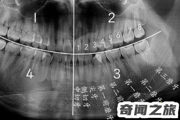 拔智齿后悔死了一时冲动拔了一颗智齿(需注意术后清洁)