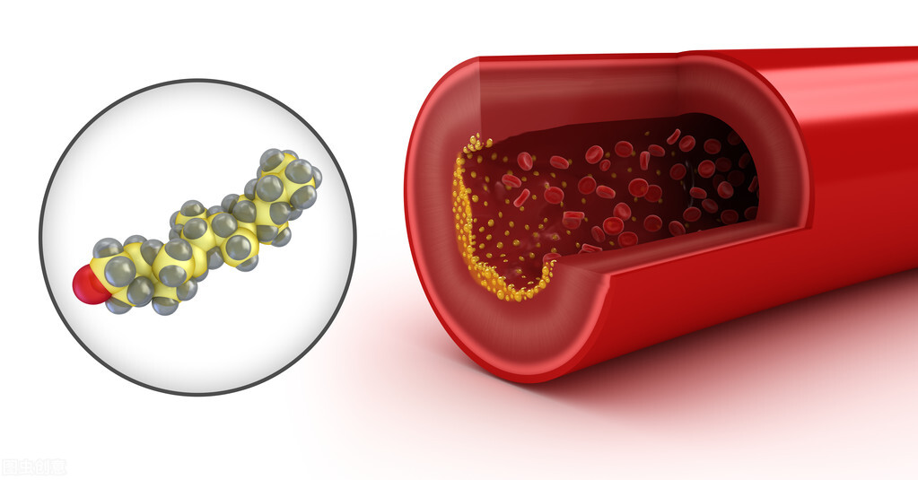 胆固醇高了对身体的坏处大吗（胆固醇高的危害怎么降下来）