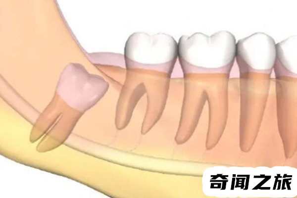 拔智齿后牙洞发白腐烂发臭（拔完智齿干槽症注意事项）