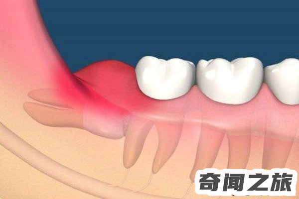 拔智齿后悔死了一时冲动拔了一颗智齿(需注意术后清洁)