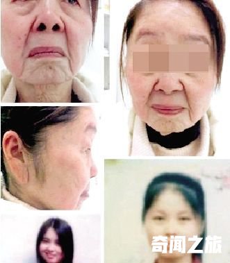 妙龄女子分娩后得面部皮肤衰老症 宛如八旬老太