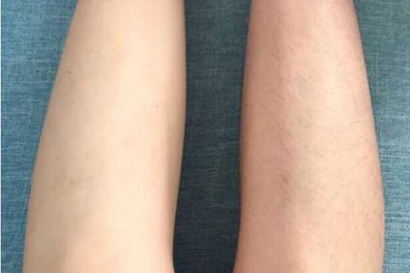 怎么去腿毛最有效?这三个女生去腿毛的方法
