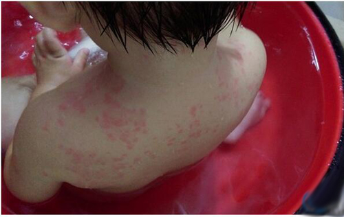 荨麻疹是怎么引起的