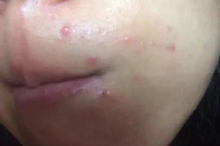 嘴角长痘痘是什么原因?这四个原因及时改善调整