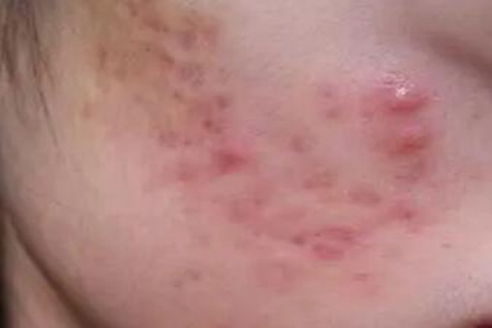 脸上长痘痘老是反反复复发怎么办？这四个因素及时改善恢复美貌