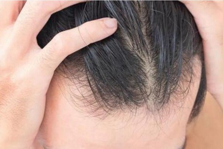 肾虚型脱发怎么改善?肾虚型脱发的原因