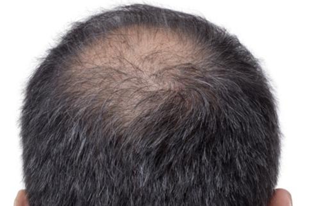 经常掉头发是什么原因,这三个原因成就男人秃头形象