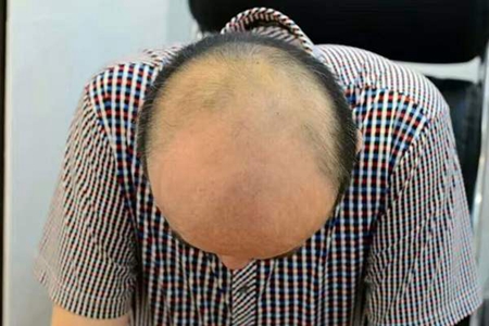 经常掉头发是什么原因,这三个原因成就男人秃头形象