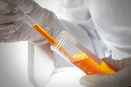 尿血是什么原因？这五个因素引发赶快对症下药