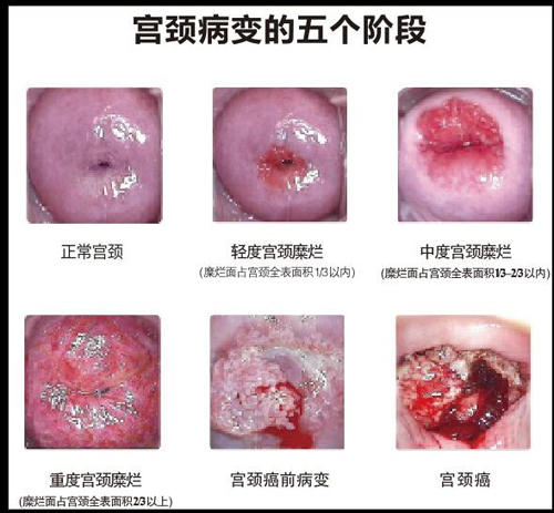 子宫颈癌的早期症状图