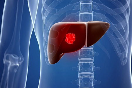 肝癌是怎么原因引起的?改掉四个不良习惯预防肝癌