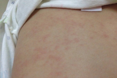 夏天宝宝长痱子怎么办?宝妈们预防小妙招