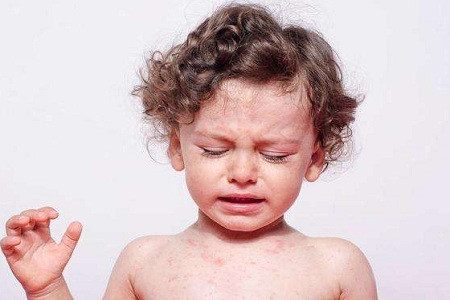 皮肤过敏找上门?调养肺脾肾来搞定