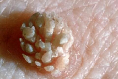 梅毒的症状是什么样子?这四个异常症状表现及时治疗