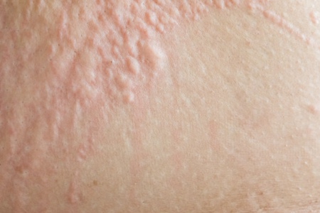 皮肤过敏不能吃什么？这五种皮肤过敏忌口食物一览