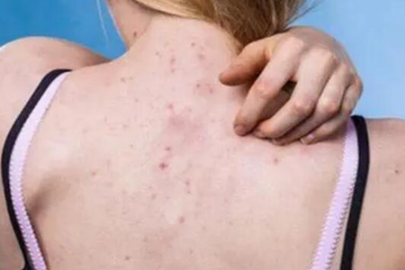 湿气重是什么原因造成的?这五个原因及时发现调理