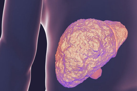 肝硬化喜欢这三类人,这两个部位会呈现肝硬化的早期症状