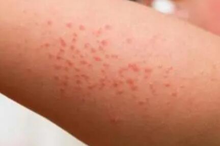 宝宝长湿疹怎么办?这四个方法护理是重点