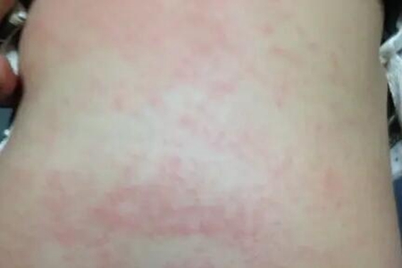 宝宝长湿疹怎么办?这四个方法护理是重点