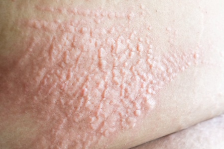 皮肤过敏不能吃什么？这五种皮肤过敏忌口食物一览