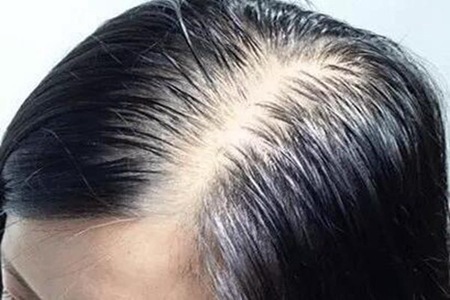 肾虚型脱发怎么改善?肾虚型脱发的原因