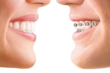 牙齿矫正大概要花费多少钱 想整牙的姐妹快看